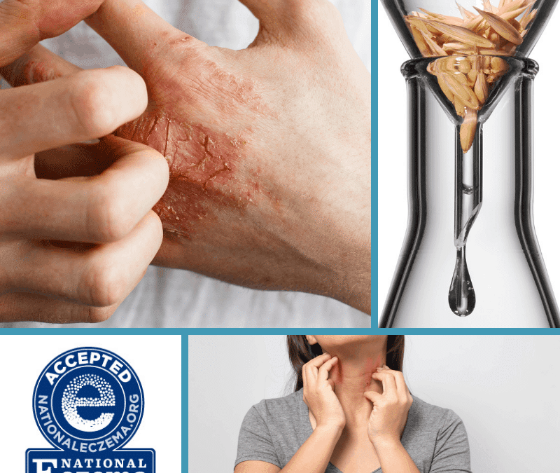best treatment for eczema